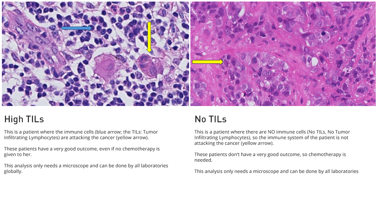 New study finds triple-negative breast cancer tumors with an increase ...